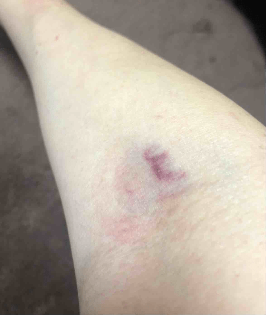 Right arm from yesterday - her first attempt