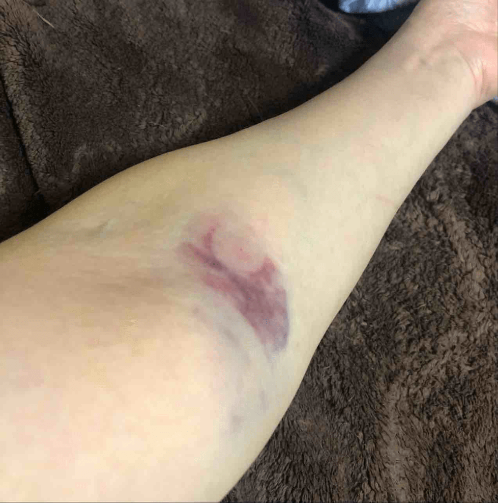 Left arm from yesterday - her second attempt - she managed to take 100ml of my blood which had to be discarded 