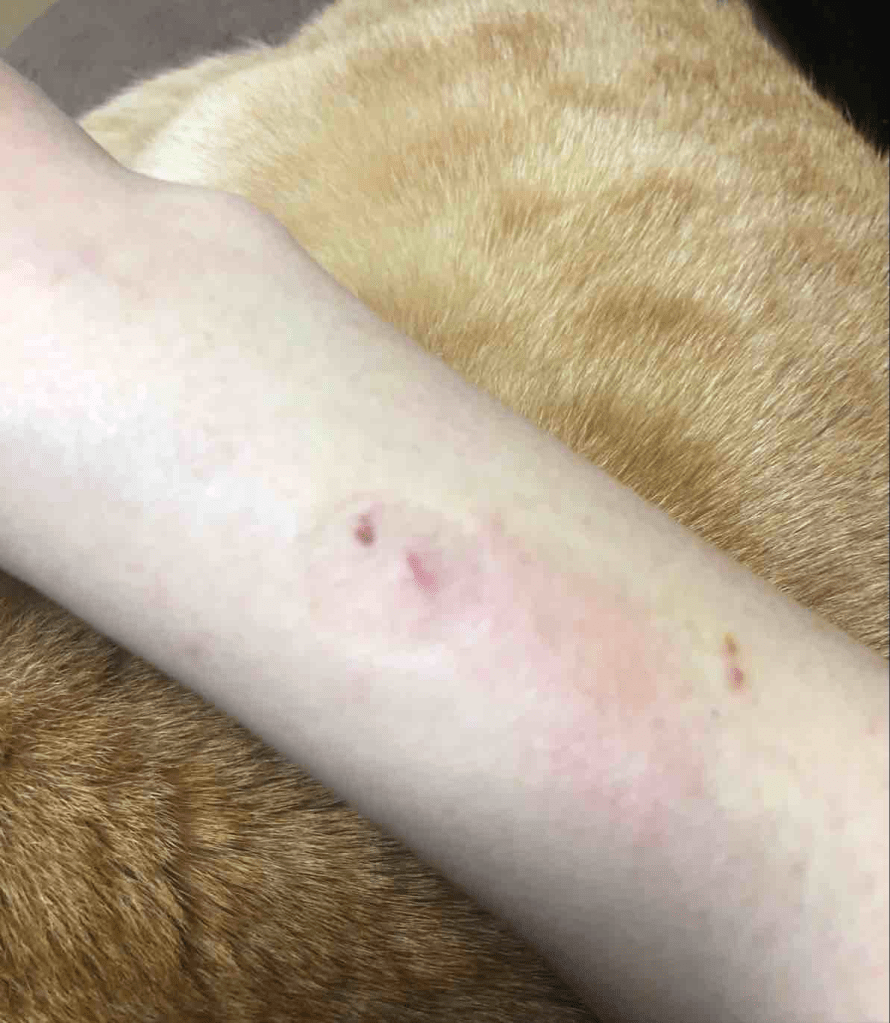 She finally succeeded to take 400ml - The swelling has gone down and it’s not purple any more!