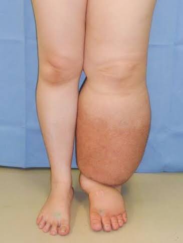 Horrible lymphedema - looks disgusting
