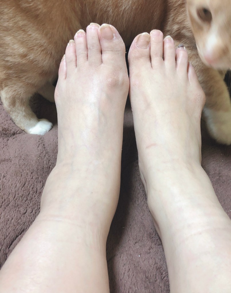 My left leg is still swollen 